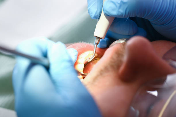 Best Emergency Tooth Extraction in East Quincy, CA