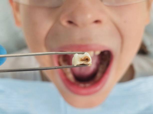 Best Emergency Gum Treatment in East Quincy, CA